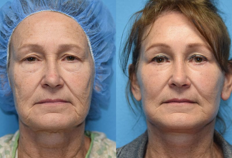 Facelift results at Maningas Cosmetic Surgery in Joplin, MO and Northwest Arkansas