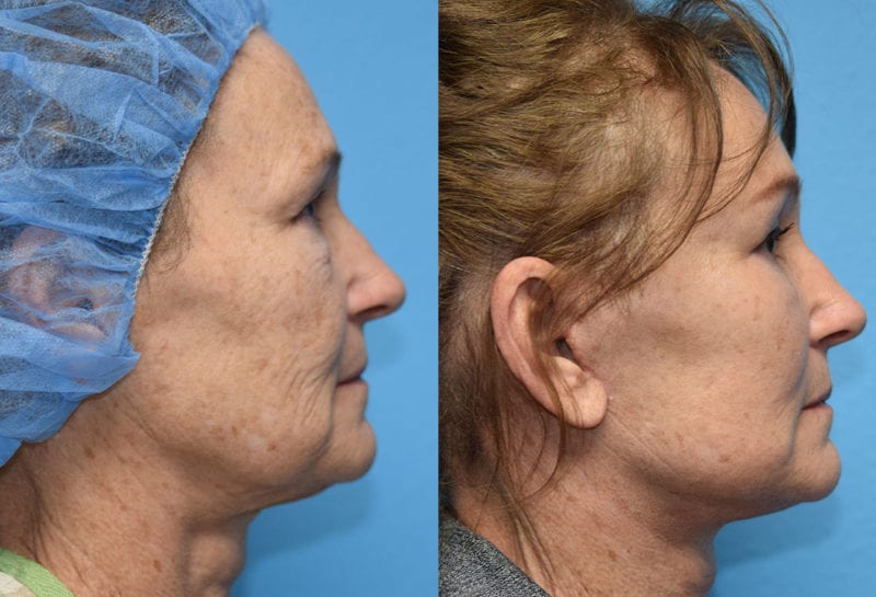 Facelift results at Maningas Cosmetic Surgery in Joplin, MO and Northwest Arkansas