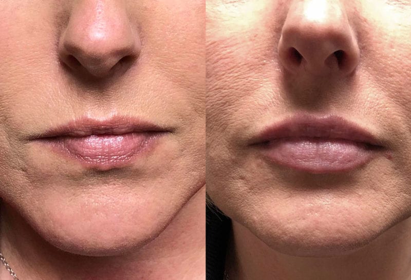 Lip Filler in Joplin, MO at Maningas Cosmetics Surgery