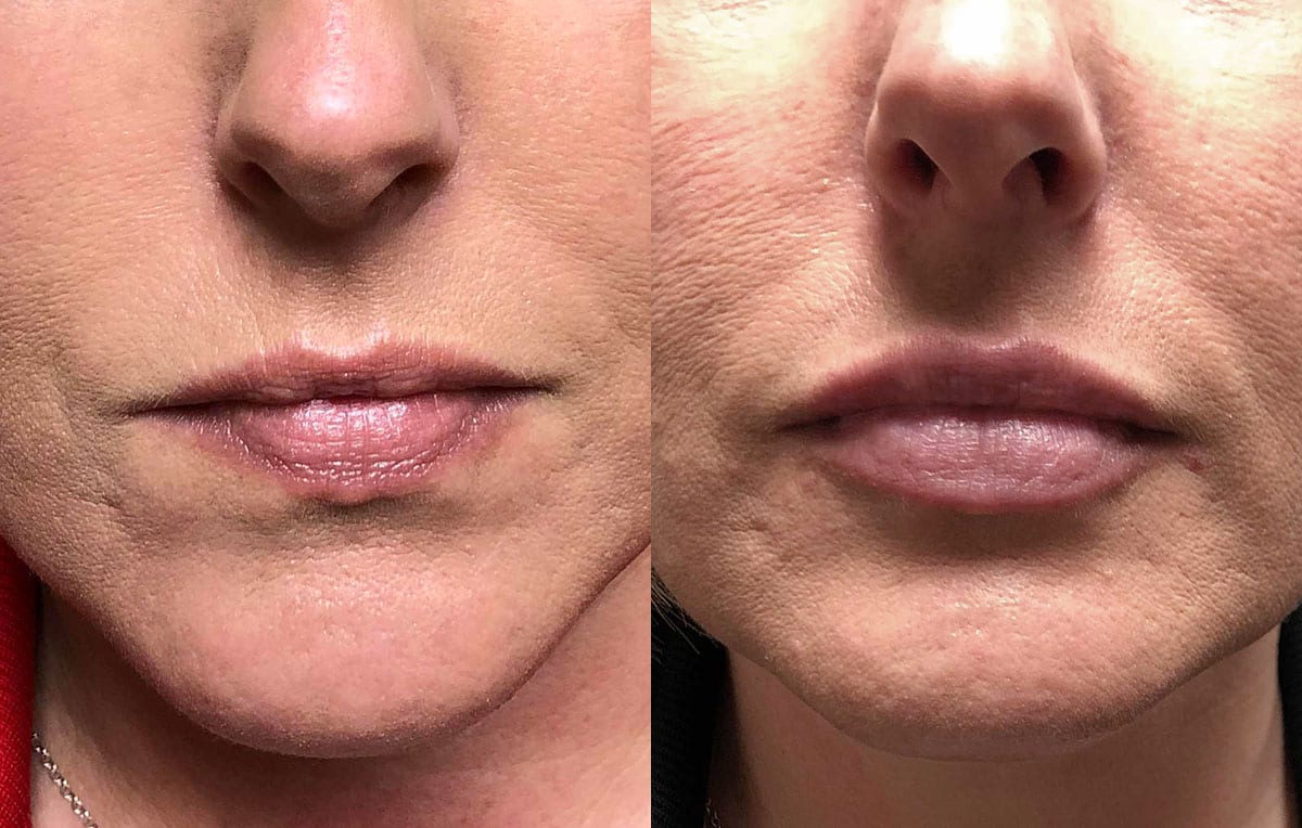 Lip Filler in Joplin, MO at Maningas Cosmetics Surgery