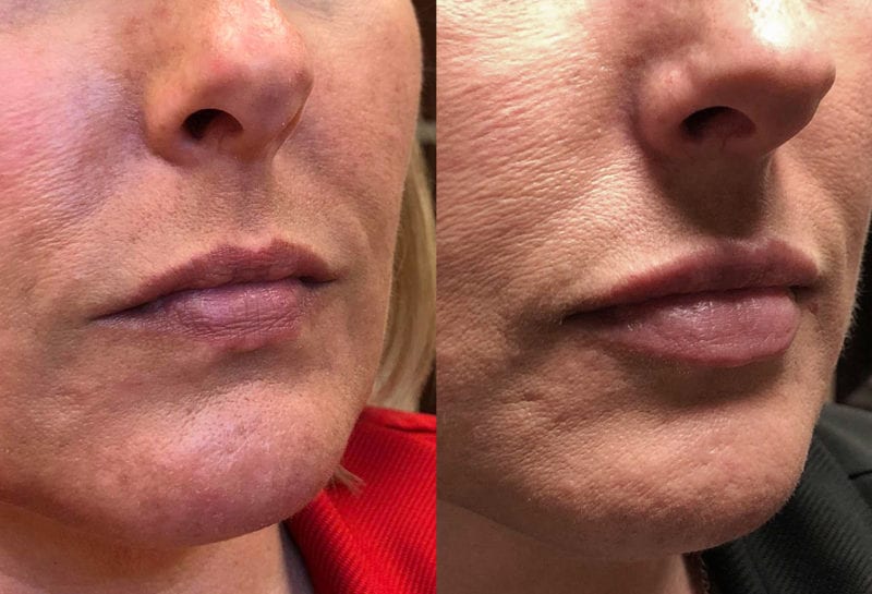 Lip Filler in Joplin, MO at Maningas Cosmetics Surgery