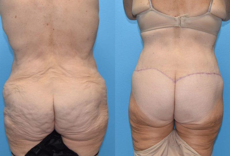 Body Lift results by Dr. Maningas at Maningas Cosmetic Surgery in Joplin, MO