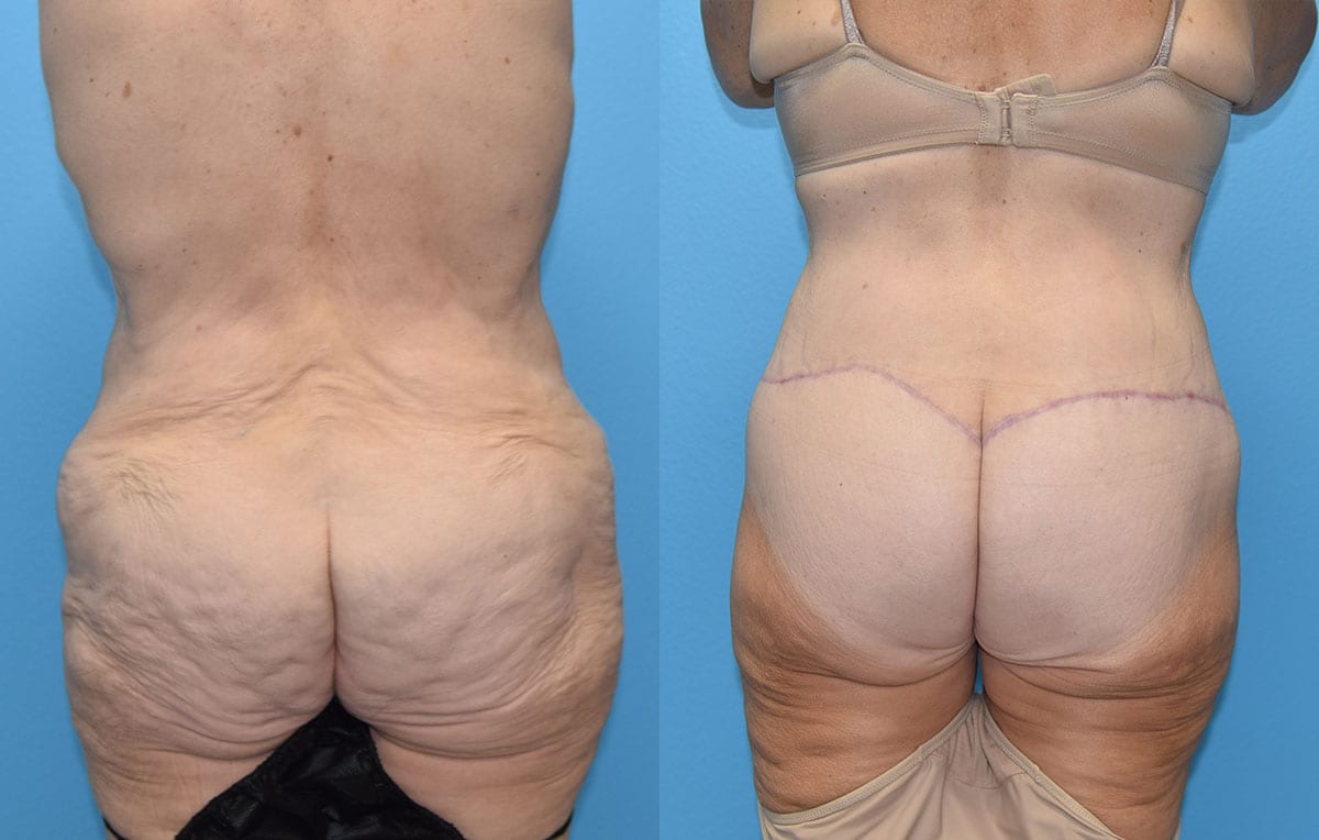 Body Lift results by Dr. Maningas at Maningas Cosmetic Surgery in Joplin, MO