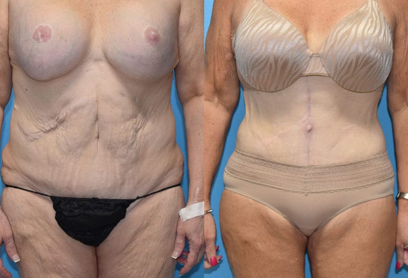 Fleur-de-lis Tummy tuck results by Dr. Maningas at Maningas Cosmetic Surgery in Joplin, MO