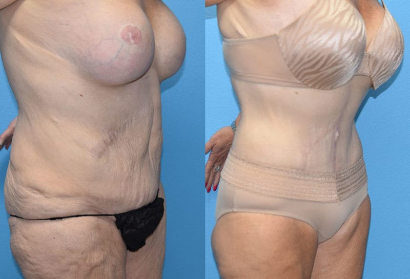 fleur-de-lis Tummy tuck results by Dr. Maningas at Maningas Cosmetic Surgery in Joplin, MO