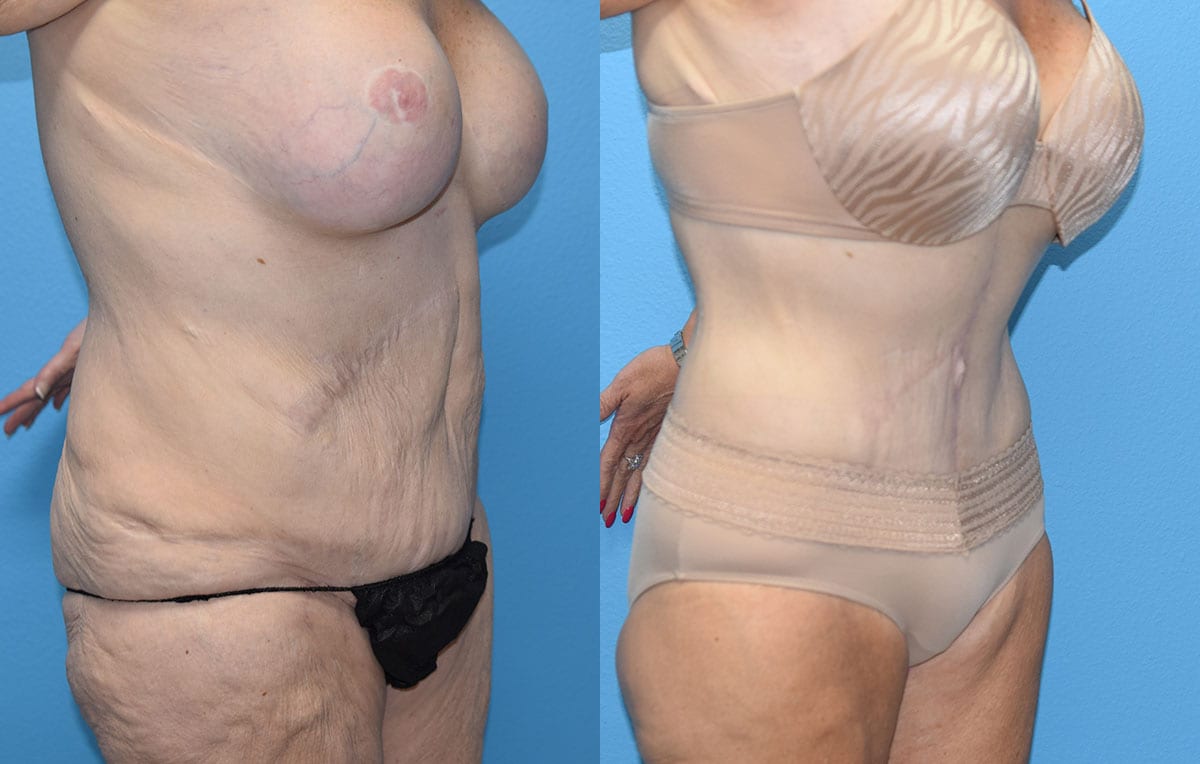 fleur-de-lis Tummy tuck results by Dr. Maningas at Maningas Cosmetic Surgery in Joplin, MO