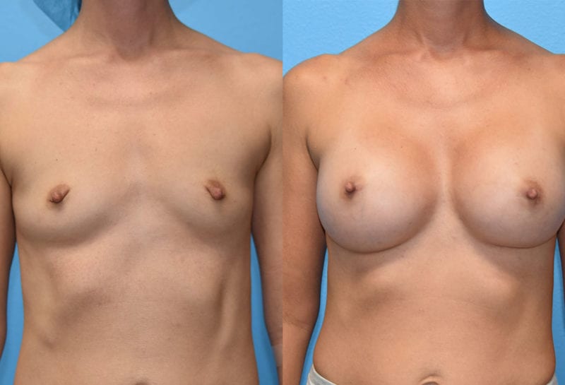 breast augmentation results by dr. maningas at maningas cosmetic surgery in joplin, mo