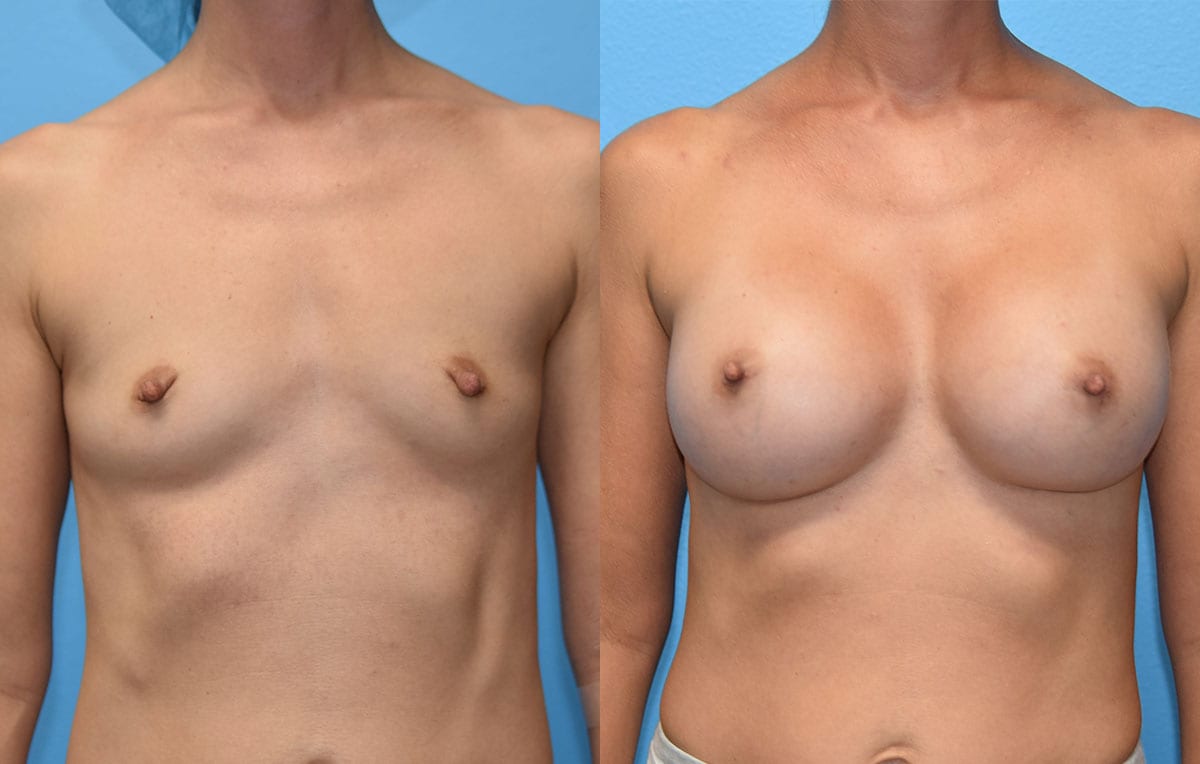 breast augmentation results by dr. maningas at maningas cosmetic surgery in joplin, mo