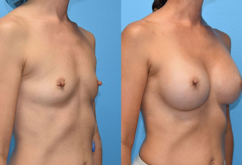 breast augmentation results by dr. maningas at maningas cosmetic surgery in joplin, mo