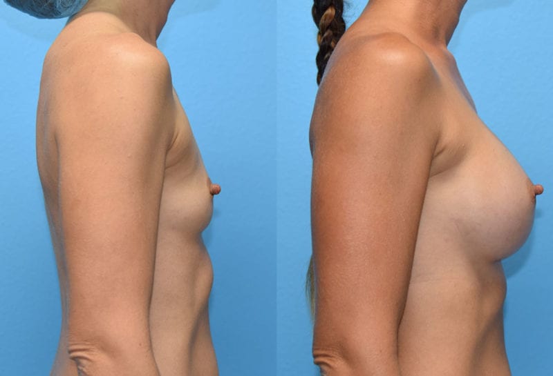 breast augmentation results by dr. maningas at maningas cosmetic surgery in joplin, mo