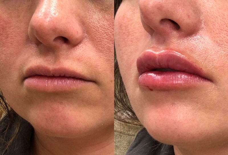 Lip Filler in Joplin, MO at Maningas Cosmetics Surgery