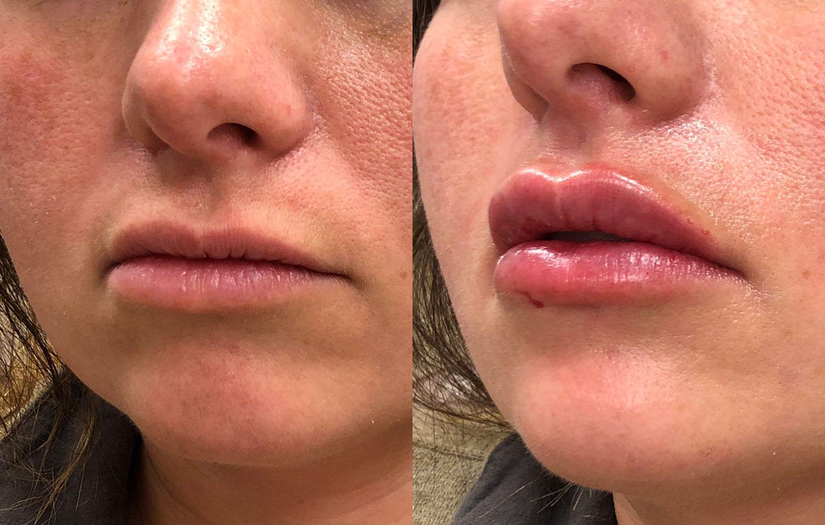 Lip Filler in Joplin, MO at Maningas Cosmetics Surgery