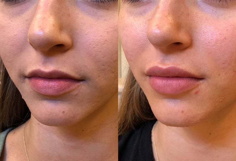 Lip Filler in Joplin, MO at Maningas Cosmetics Surgery