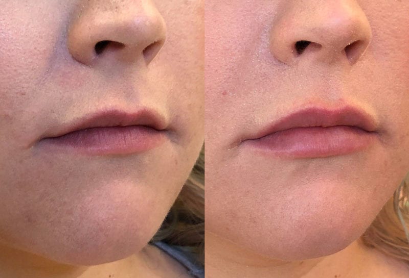 Lip Filler in Joplin, MO at Maningas Cosmetics Surgery