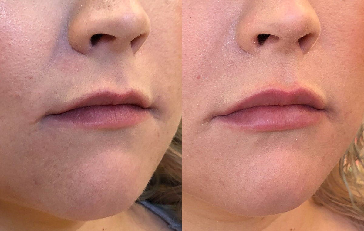 Lip Filler in Joplin, MO at Maningas Cosmetics Surgery