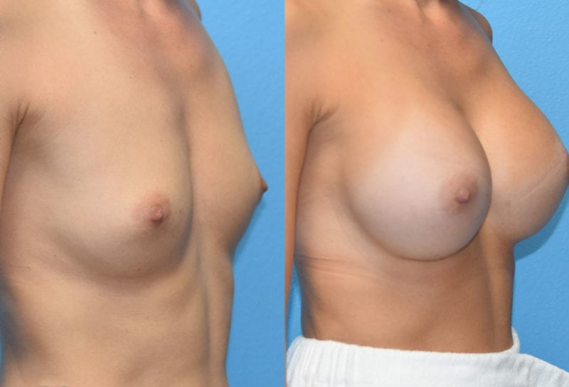 breast augmentation results by dr. maningas at maningas cosmetic surgery in joplin, mo