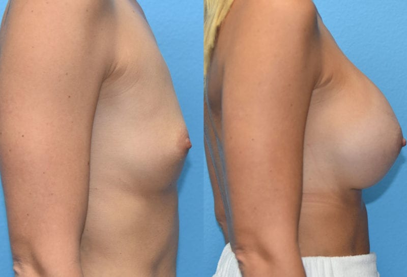 breast augmentation results by dr. maningas at maningas cosmetic surgery in joplin, mo