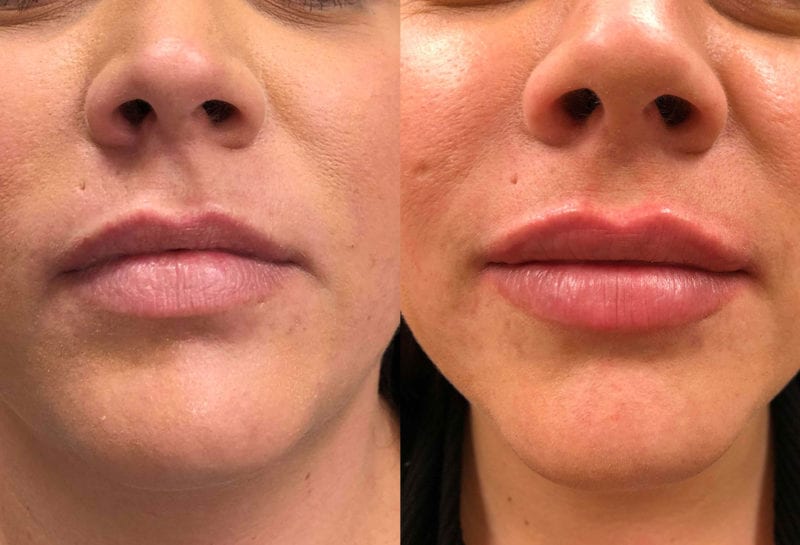 Lip Filler in Joplin, MO at Maningas Cosmetics Surgery