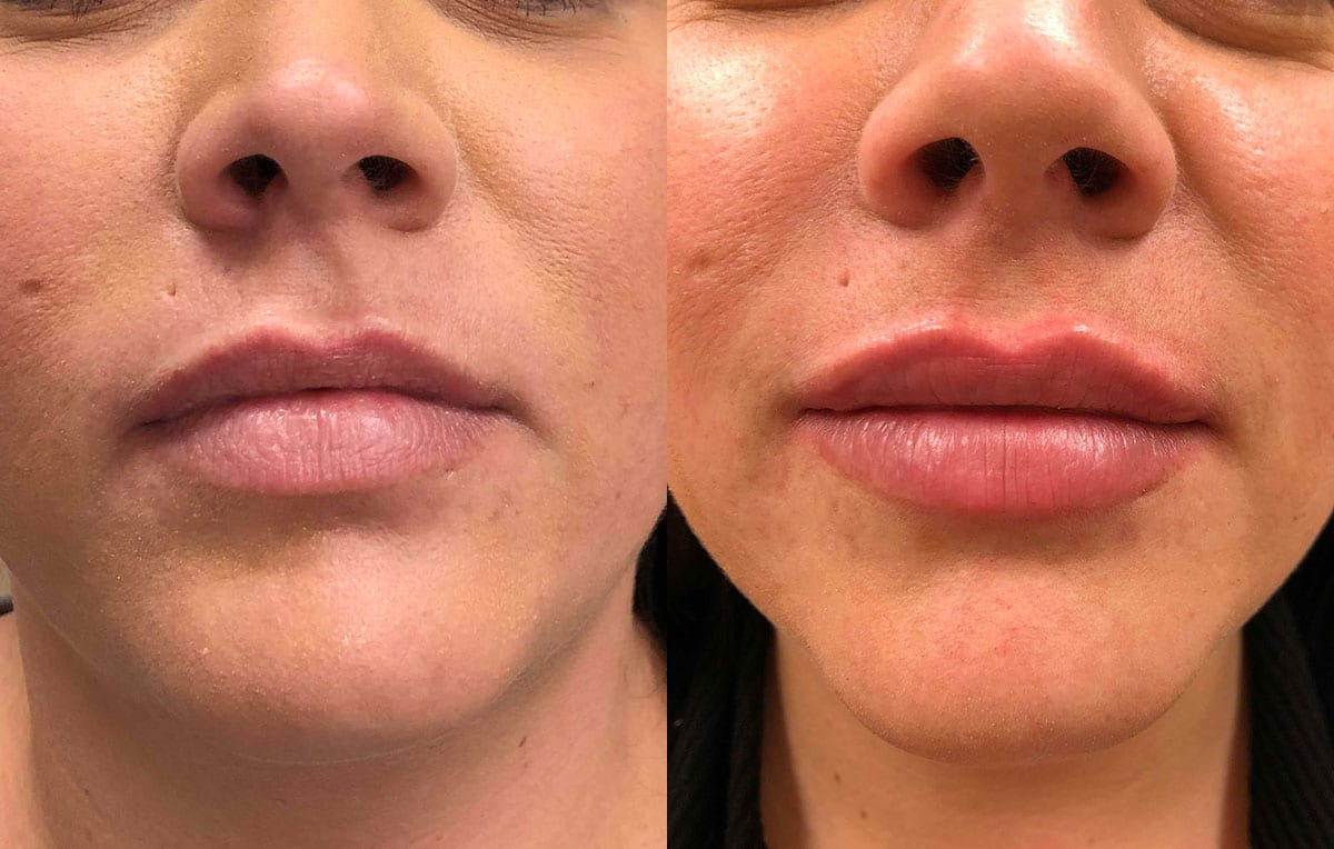 Lip Filler in Joplin, MO at Maningas Cosmetics Surgery