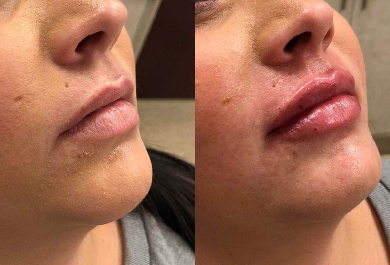 Lip Filler in Joplin, MO at Maningas Cosmetics Surgery