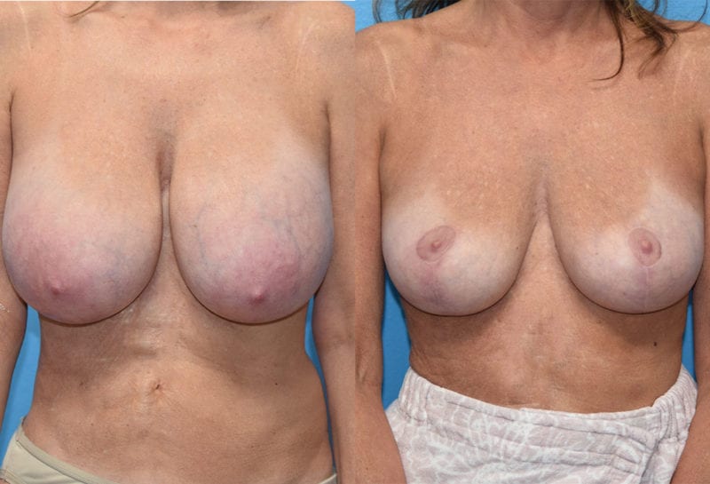 Cosmetic breast revision results by Dr. Maningas at Maningas Cosmetic Surgery in Missouri and Arkansas