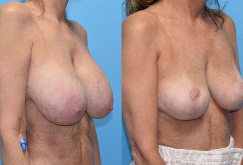 Cosmetic breast revision results by Dr. Maningas at Maningas Cosmetic Surgery in Missouri and Arkansas