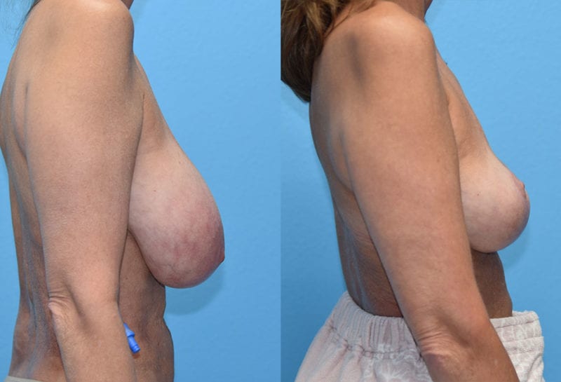 Cosmetic breast revision results by Dr. Maningas at Maningas Cosmetic Surgery in Missouri and Arkansas