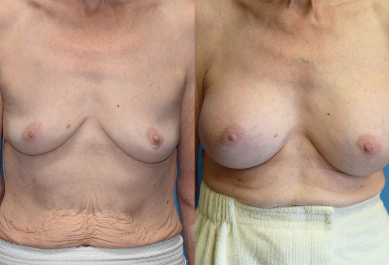 breast augmentation results by dr. maningas at maningas cosmetic surgery in joplin, mo