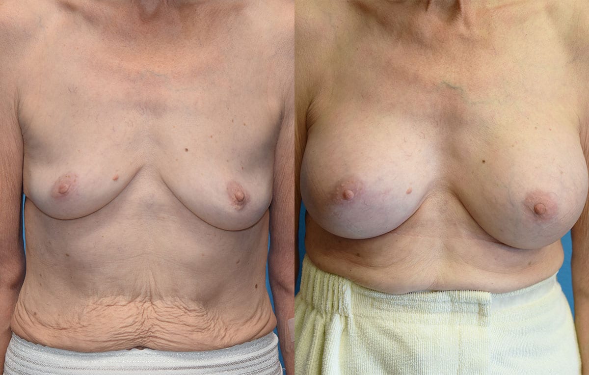 breast augmentation results by dr. maningas at maningas cosmetic surgery in joplin, mo