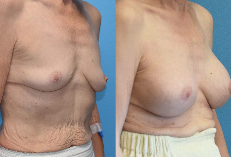 breast augmentation results by dr. maningas at maningas cosmetic surgery in joplin, mo