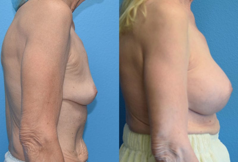 breast augmentation results by dr. maningas at maningas cosmetic surgery in joplin, mo