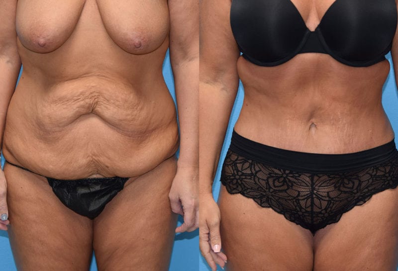 Tummy tuck results by Dr. Maningas at Maningas Cosmetic Surgery in Joplin, MO