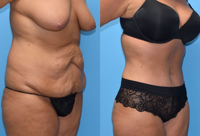 Tummy tuck results by Dr. Maningas at Maningas Cosmetic Surgery in Joplin, MO