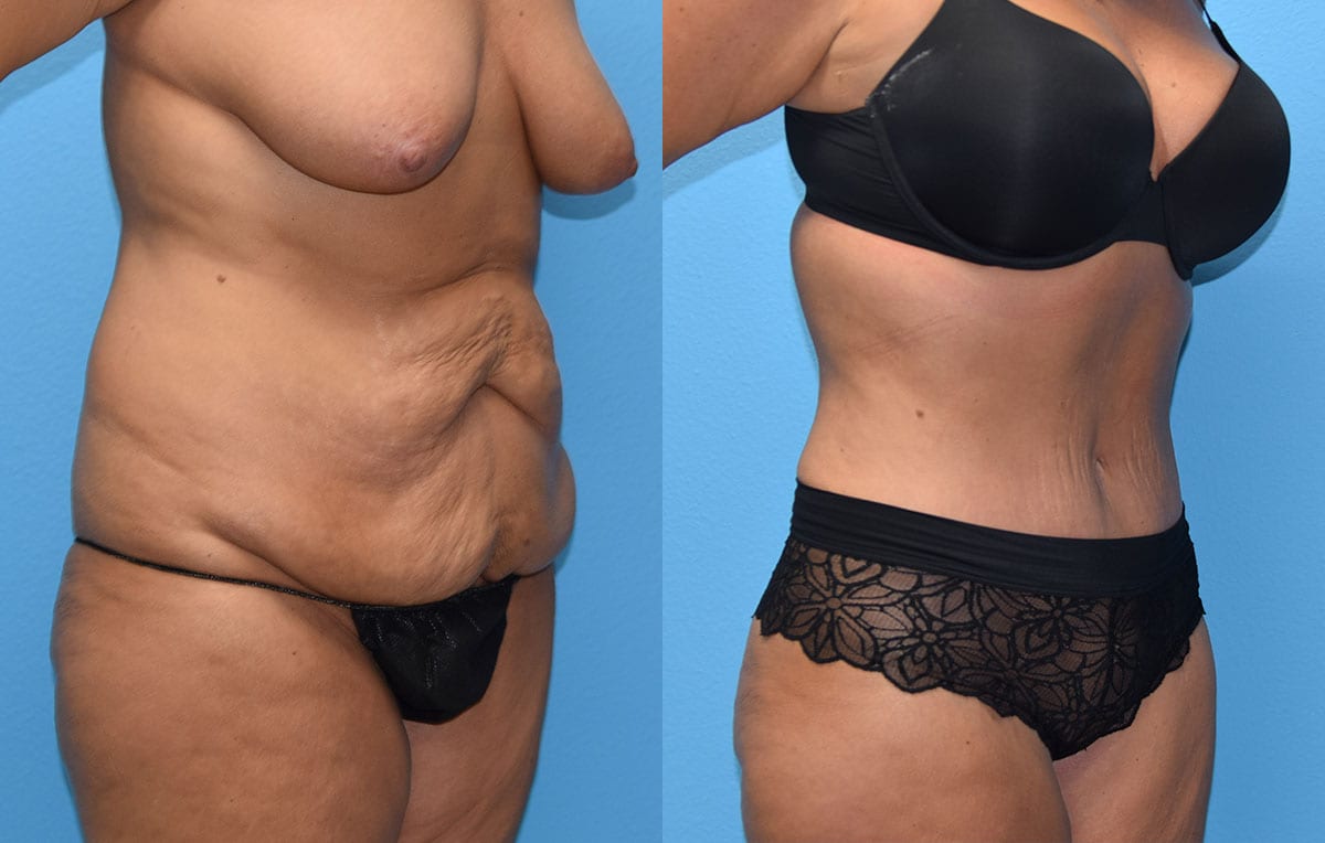 Tummy tuck results by Dr. Maningas at Maningas Cosmetic Surgery in Joplin, MO