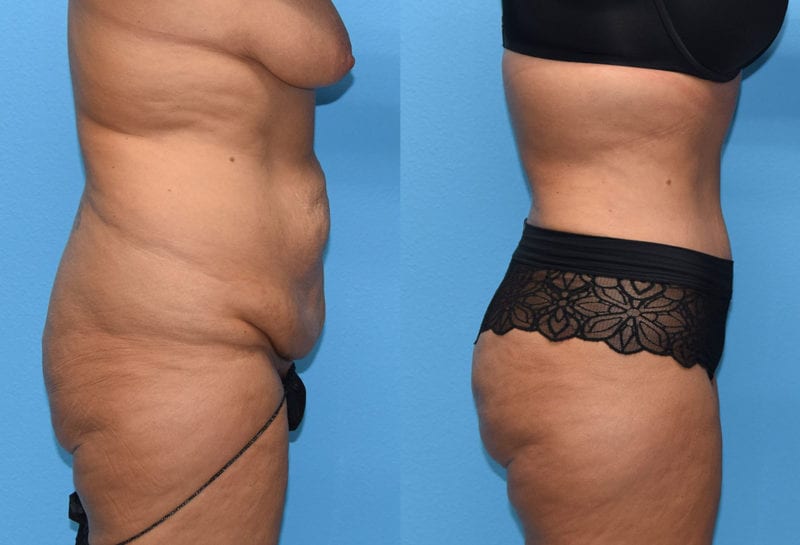 Tummy tuck results by Dr. Maningas at Maningas Cosmetic Surgery in Joplin, MO