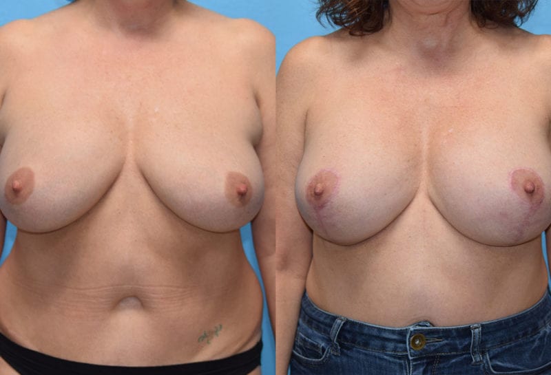 Breast Lift with Implant results by Dr. Maningas at Maningas Cosmetic Surgery in Missouri and Arkansas