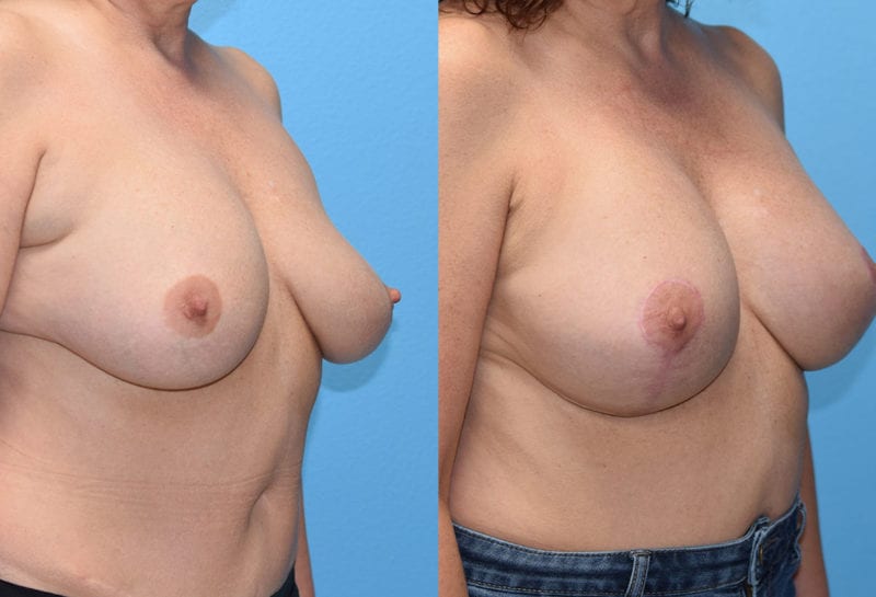 Breast Lift with Implant results by Dr. Maningas at Maningas Cosmetic Surgery in Missouri and Arkansas