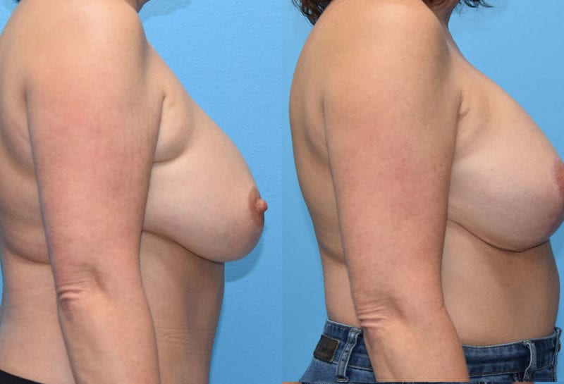 Breast Lift with Implant results by Dr. Maningas at Maningas Cosmetic Surgery in Missouri and Arkansas