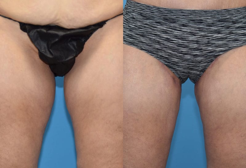 Inner Thigh Lift by Dr. Maningas at Maningas Cosmetic Surgery in Joplin, MO