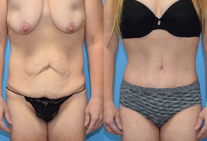 Tummy tuck results by Dr. Maningas at Maningas Cosmetic Surgery in Joplin, MO