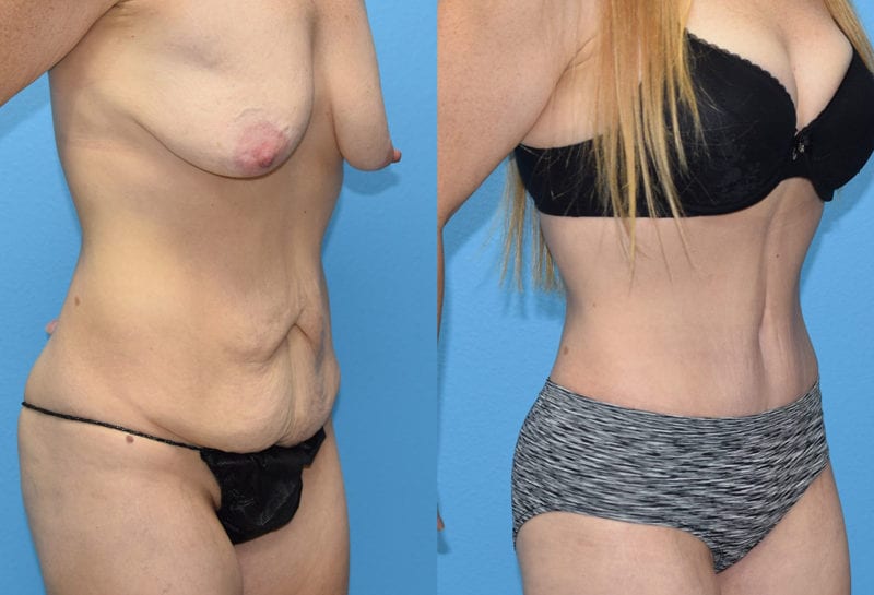 Tummy tuck results by Dr. Maningas at Maningas Cosmetic Surgery in Joplin, MO