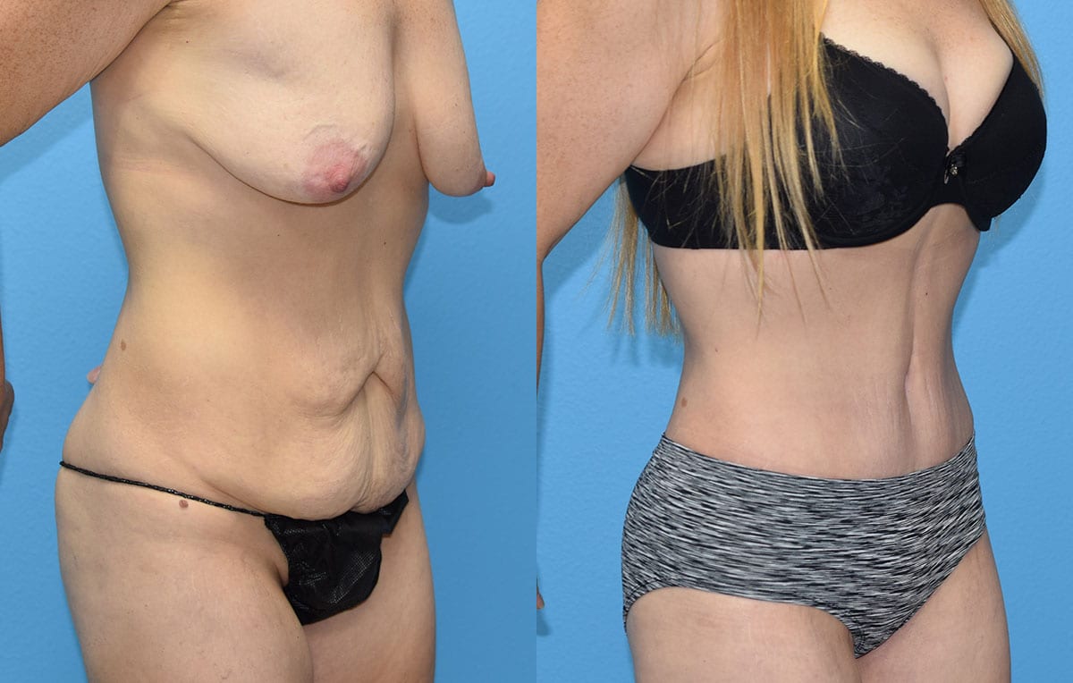 Tummy tuck results by Dr. Maningas at Maningas Cosmetic Surgery in Joplin, MO