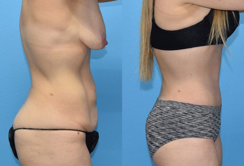 Tummy tuck results by Dr. Maningas at Maningas Cosmetic Surgery in Joplin, MO