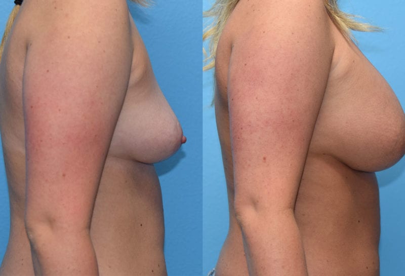 breast augmentation results by dr. maningas at maningas cosmetic surgery in joplin, mo