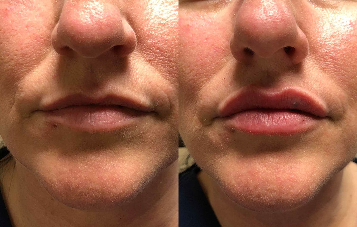 Lip Filler in Joplin, MO at Maningas Cosmetics Surgery