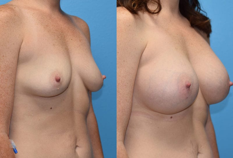 breast augmentation results by dr. maningas at maningas cosmetic surgery in joplin, mo