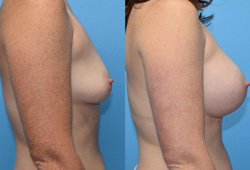 breast augmentation results by dr. maningas at maningas cosmetic surgery in joplin, mo