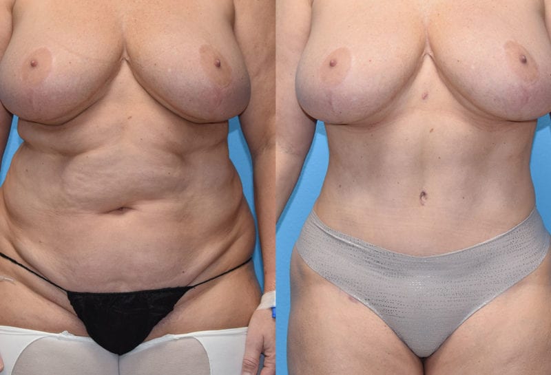 Tummy tuck results by Dr. Maningas at Maningas Cosmetic Surgery in Joplin, MO