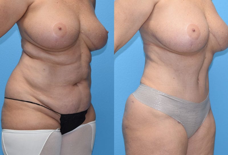 Tummy tuck results by Dr. Maningas at Maningas Cosmetic Surgery in Joplin, MO