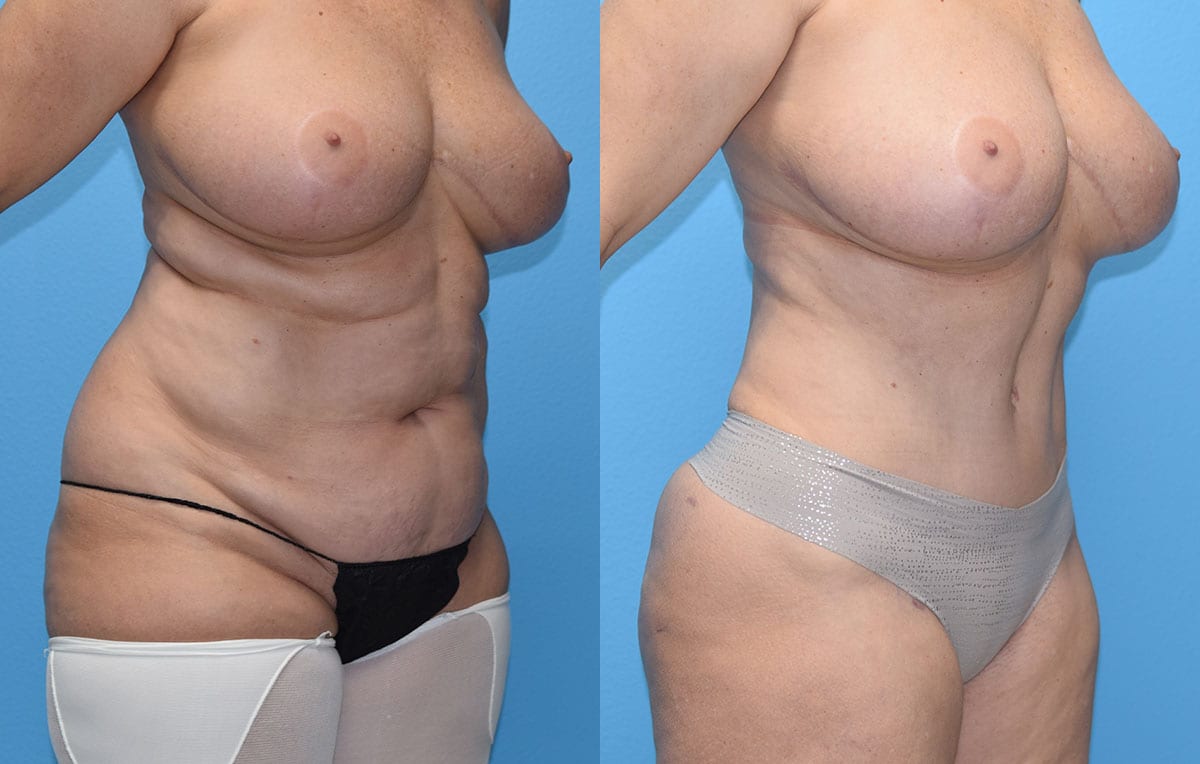 Tummy tuck results by Dr. Maningas at Maningas Cosmetic Surgery in Joplin, MO